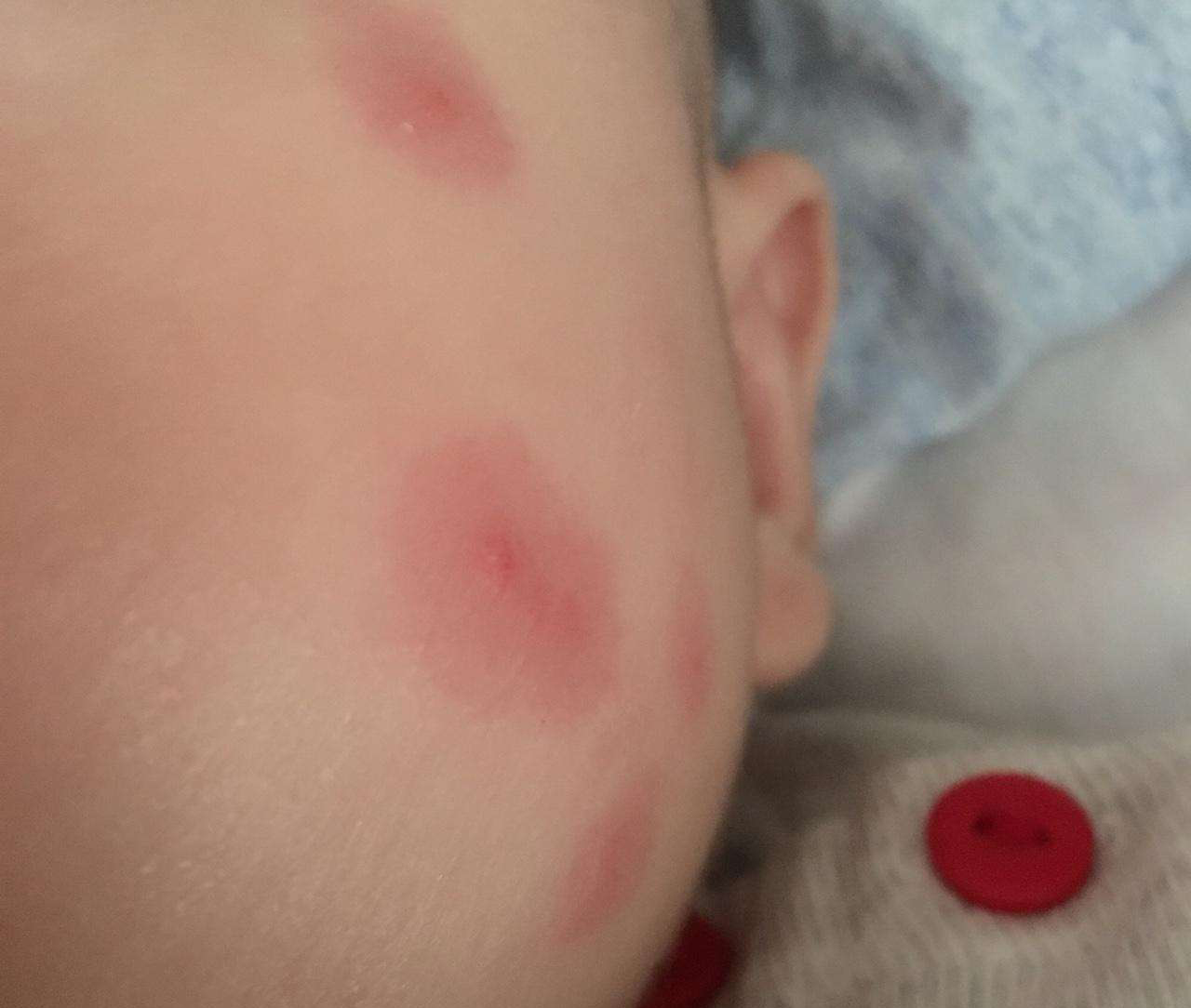 宝宝蚊虫叮咬宝宝细皮嫩肉,蚊子很容易刺穿皮肤,相比较起来,大人的
