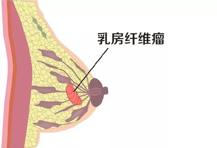 做女人好难,女性好发的乳腺纤维瘤要手术吗?