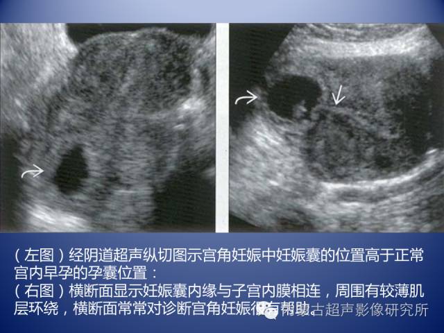 【超声微课堂】宫角妊娠