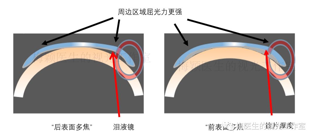 探秘儿童近视控制的新工具多焦接触镜之多焦rgp