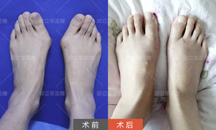 圣嘉新邱立东这些明星也逃不过大脚骨的困惑