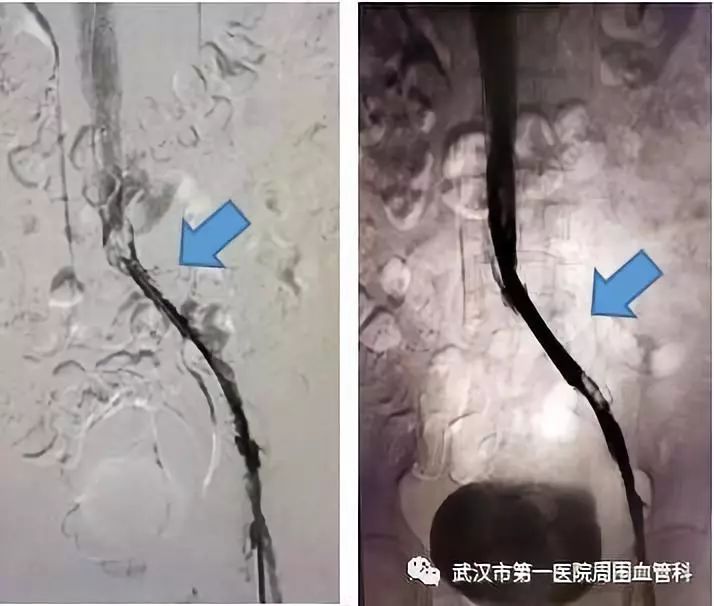 下肢静脉回流障碍----重视髂静脉受压综合征筛查和治疗