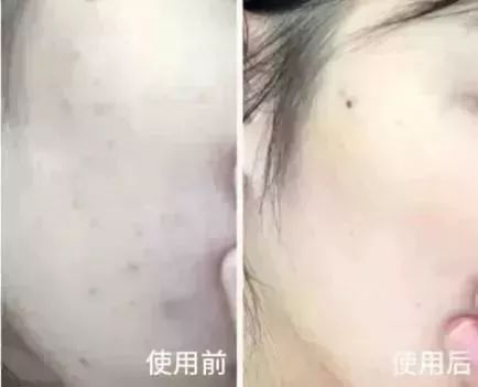                     宝宝摔伤磕伤之后，如何处理才能避免留疤？
