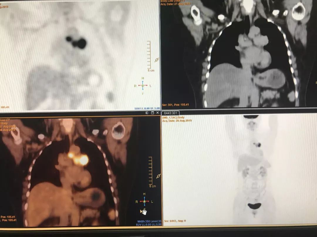 会出现肥大性骨关节病,男性乳房发育,低钠血症,高钙血症等副癌综合征