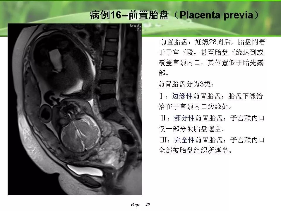 胎儿磁共振成像丨影像天地