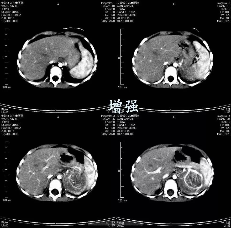 神经母细胞瘤