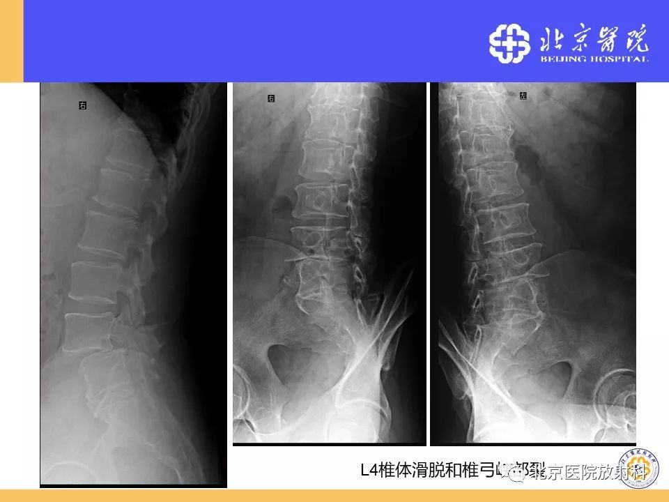 精彩推荐 | 椎管狭窄的影像学检查