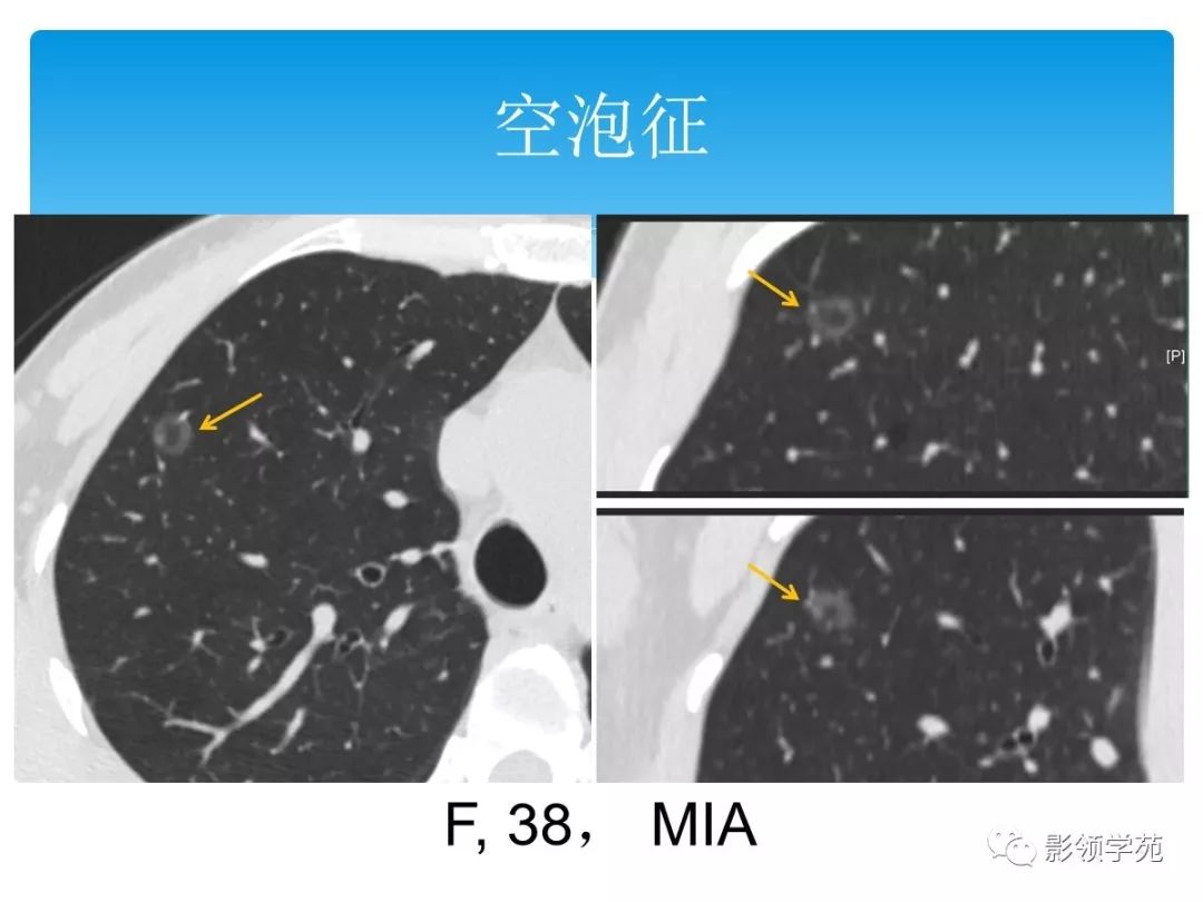 高分辨率ct在早期肺癌诊断及鉴别诊断中的价值