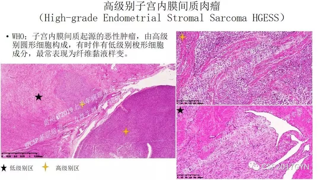 中华病理学会基层培训遵义站讲座(六)——子宫内膜间质肿瘤的病理诊断