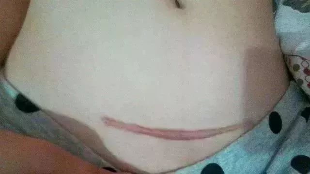                     宝宝摔伤磕伤之后，如何处理才能避免留疤？