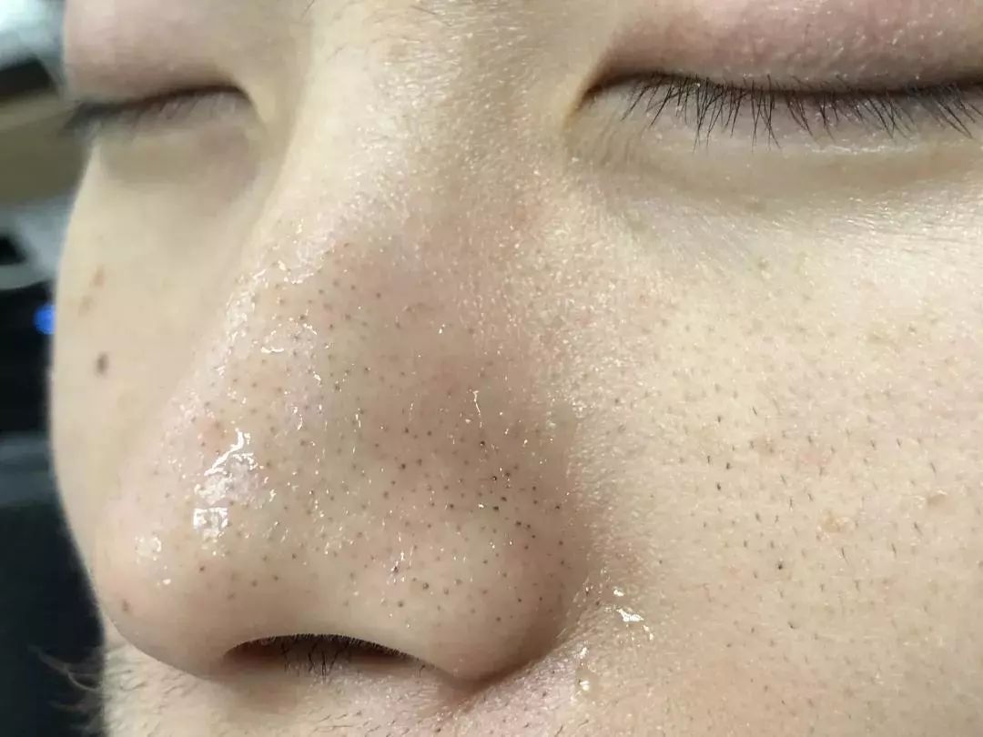 好物 | 太爽了!一次就能清掉一整年的黑头，全脸嫩滑无死角!