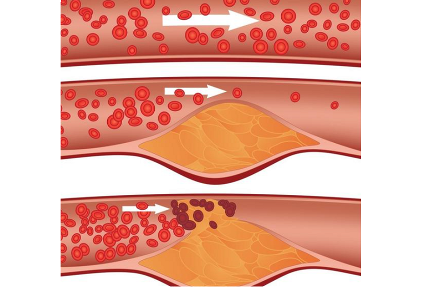 动脉硬化,动脉粥样硬化,动脉斑块,它们是一回事吗?今天终于清楚了