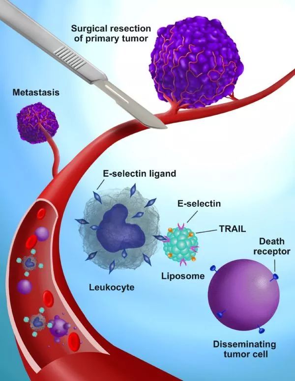 science子刊:纳米药物包裹的白细胞可以有效杀死手术过程脱落的癌细胞