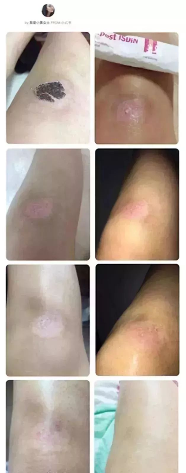                     宝宝摔伤磕伤之后，如何处理才能避免留疤？