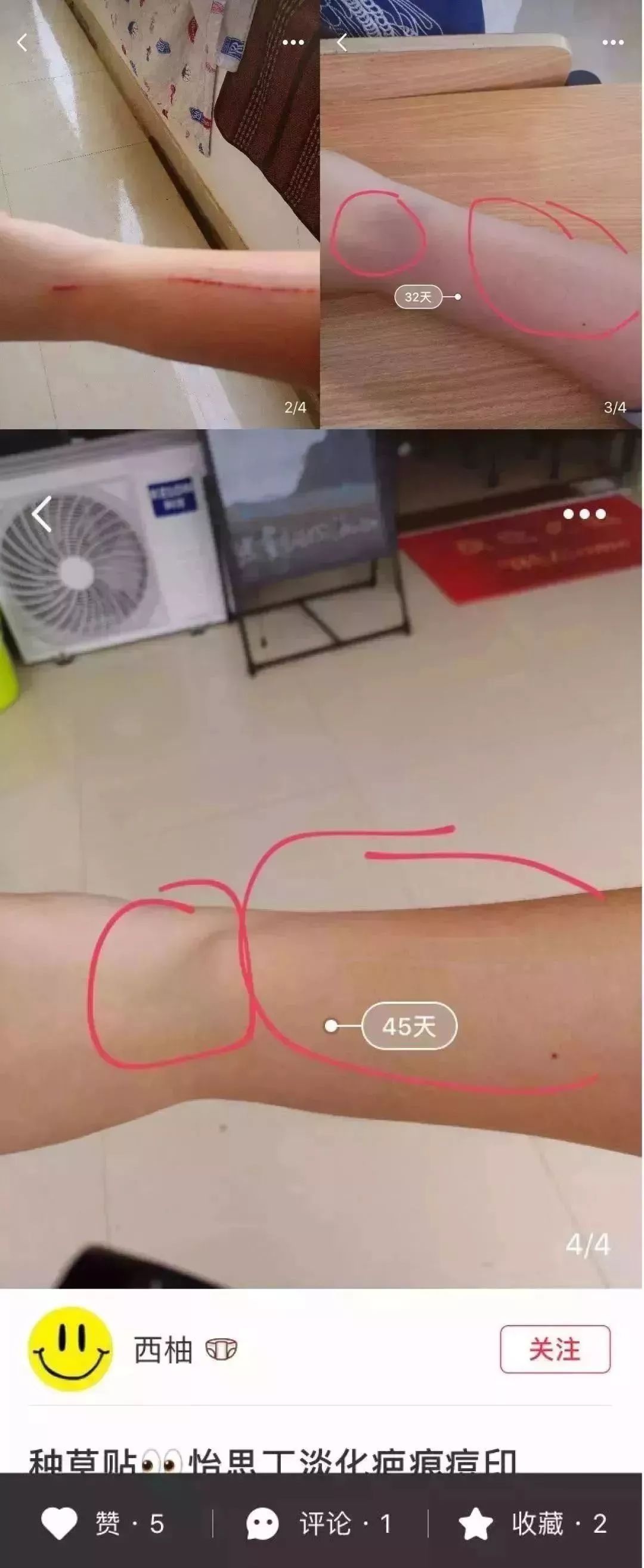                     宝宝摔伤磕伤之后，如何处理才能避免留疤？