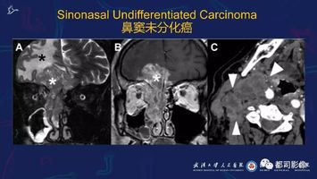 嗅神经母细胞瘤影像诊断