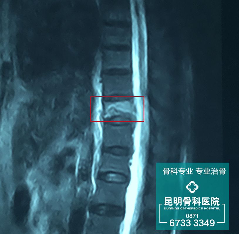 图为核磁共振资料显示胸11椎体压缩性骨折
