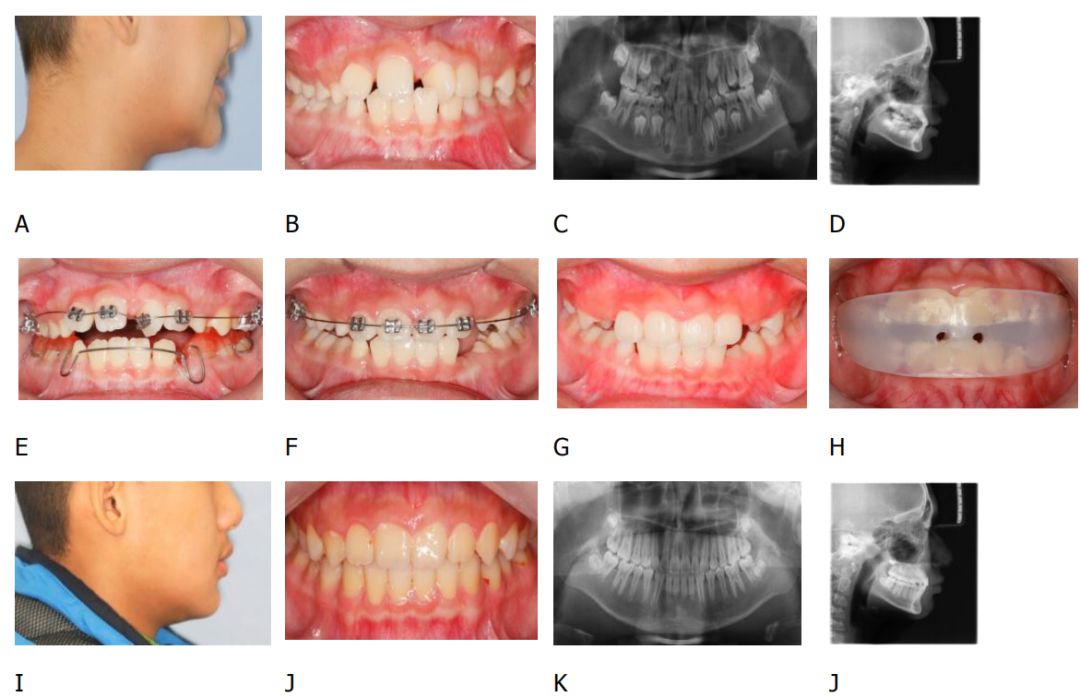 病例三:11岁8个月女童,开牙合,咬合诱导治疗,12岁建生理牙合.