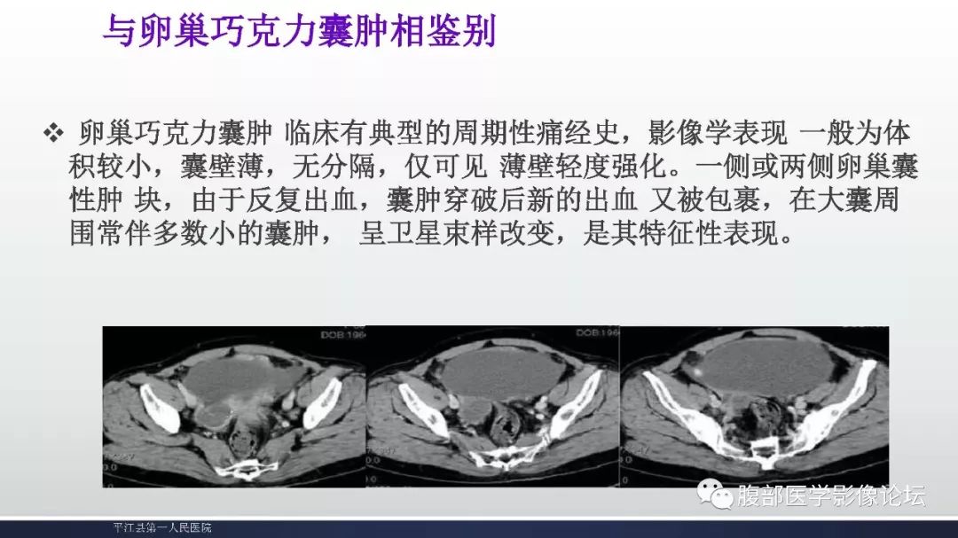 卵巢黏液性囊腺瘤影像表现