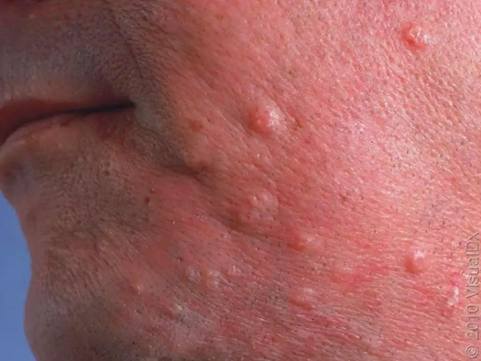 皮损图片 12