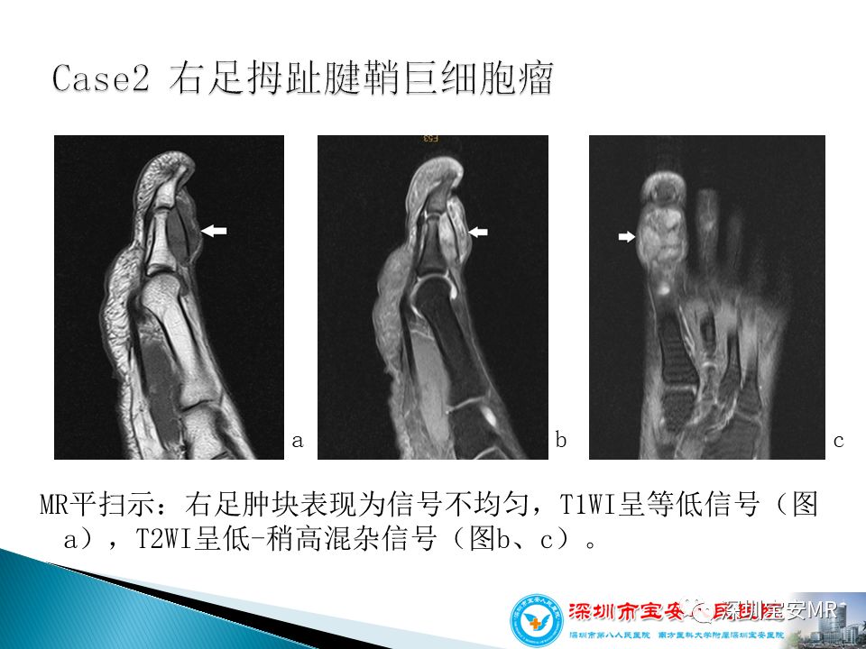 腱鞘巨细胞瘤临床病理与影像