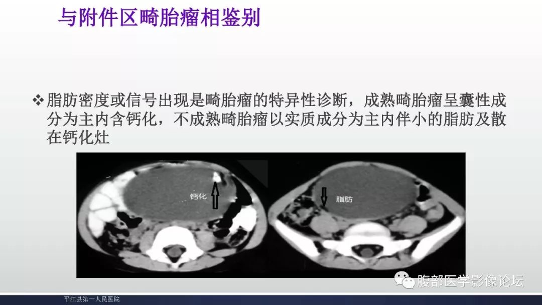 卵巢黏液性囊腺瘤影像表现