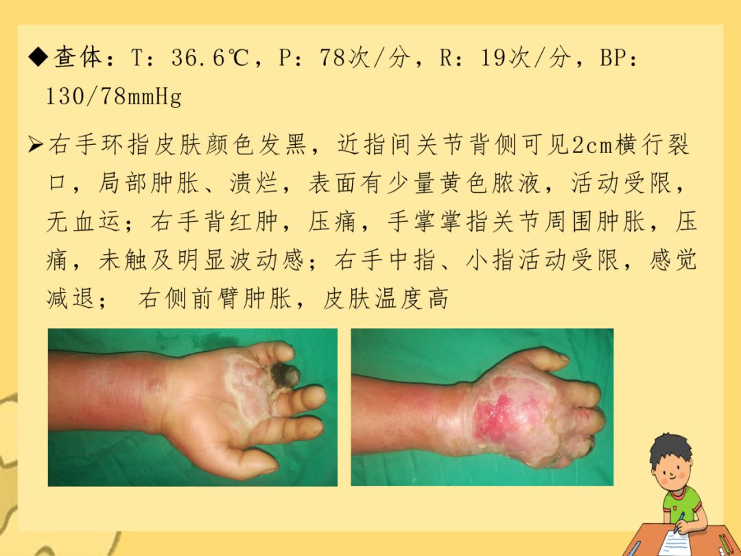 走进临床02期丨糖尿病手坏疽的诊治与防控