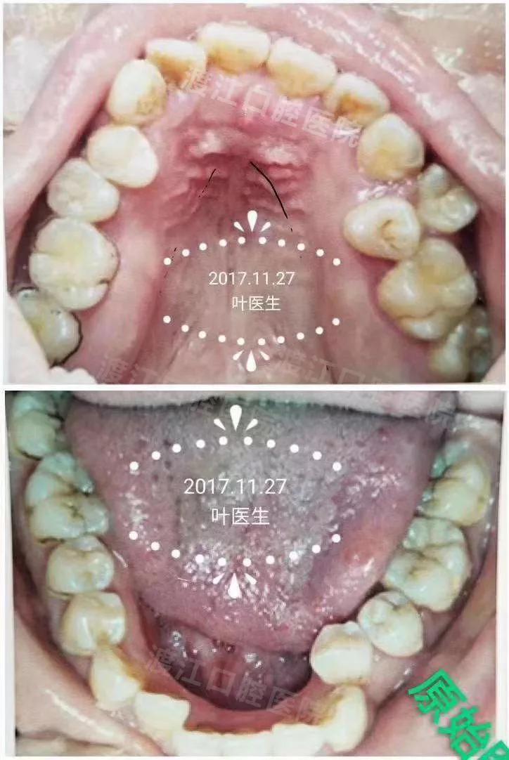 渡江口腔优秀病例展示歪脸牙齿不齐正畸