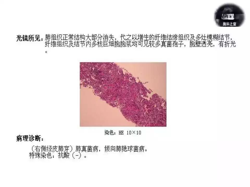 242期轮值病例结果肺隐球菌病