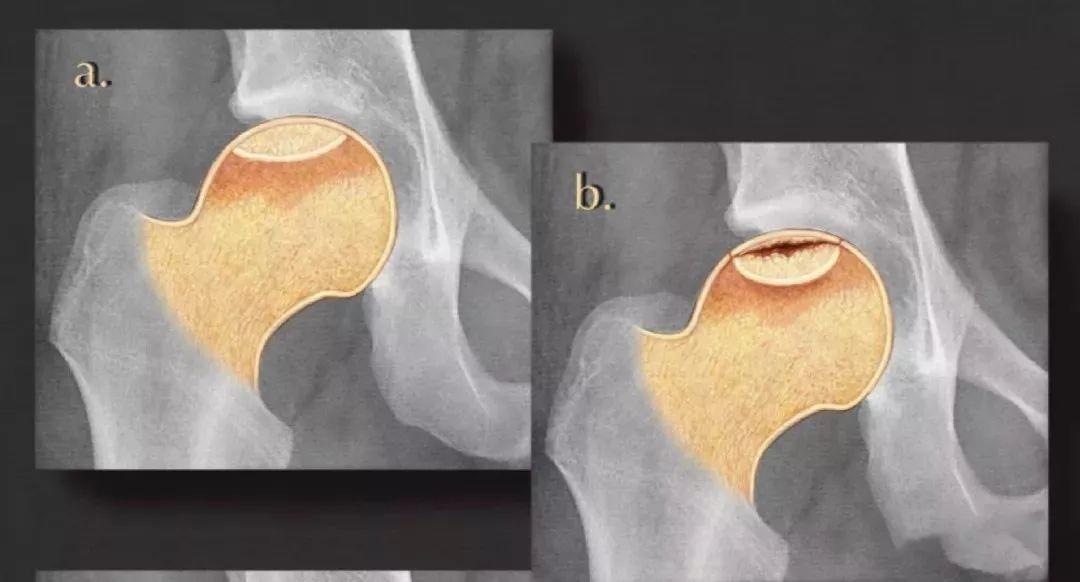 【公益科普】股骨头缺血性坏死的分期及临床表现