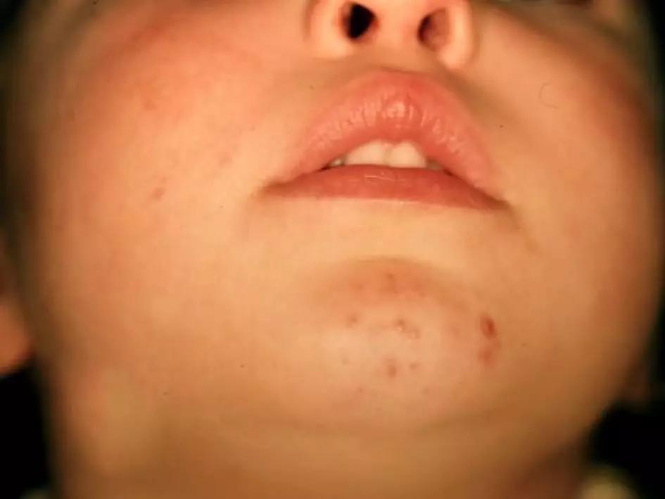 皮损图片 17. 婴儿痤疮