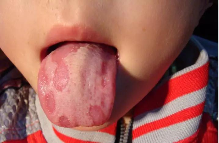 地图舌如果孩子的大便干燥,腹胀明显,可以遵医嘱,食一些消食导滞作用