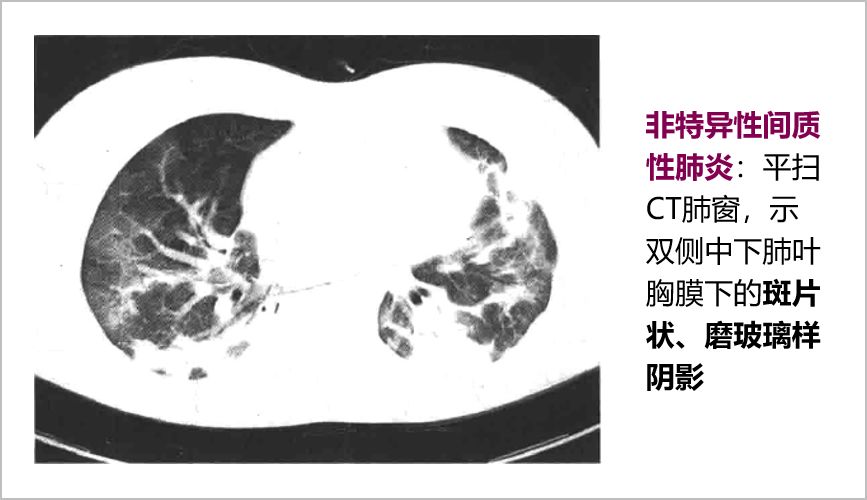 肺气肿,肺不张,良性肺结节,恶性肺结节,大叶性肺炎,间质性肺炎,肺脓肿