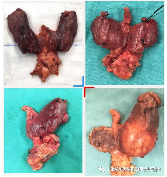 彩超和mri检查可发现腮腺肿瘤的数目及具体位置.