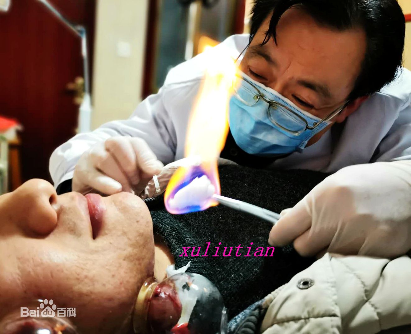 许柳田主任医师 火针治疗面部颌下疤痕性痤疮