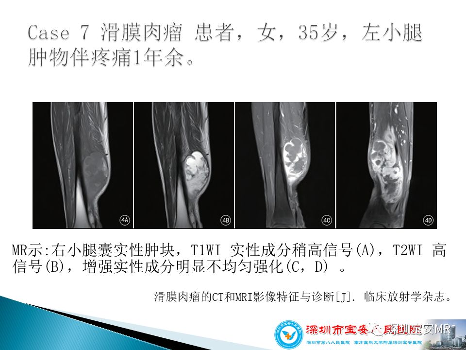 腱鞘巨细胞瘤临床病理与影像