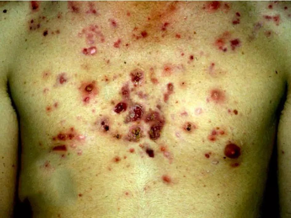 皮损图片 15. 暴发性痤疮