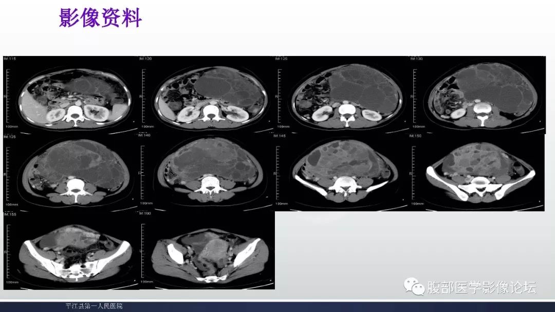 卵巢黏液性囊腺瘤影像表现