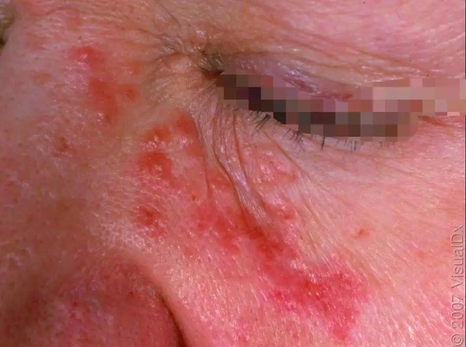 皮损图片 9
