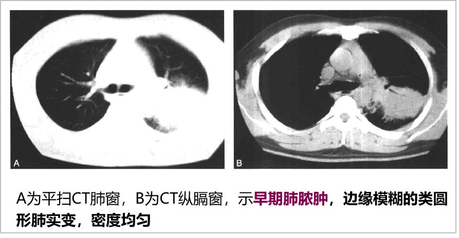 胸部常见病变ct影像解读_胸膜