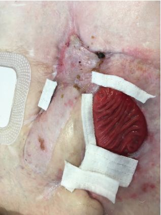 一个月后,伤口完全呈颗粒状,eaf也好了,整形外科给患者做了植皮手术