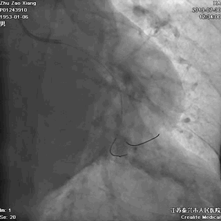 冠状动脉造影提示左冠回旋支急性闭塞,前降支心肌桥形成,心肌桥两端各