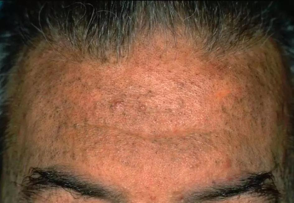 皮损图片 14. 氯痤疮