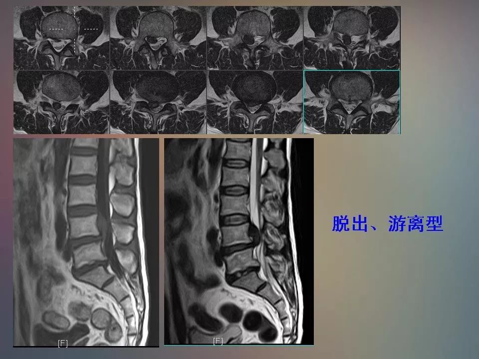 腰椎退行性变腰痛的mr诊断丨影像天地