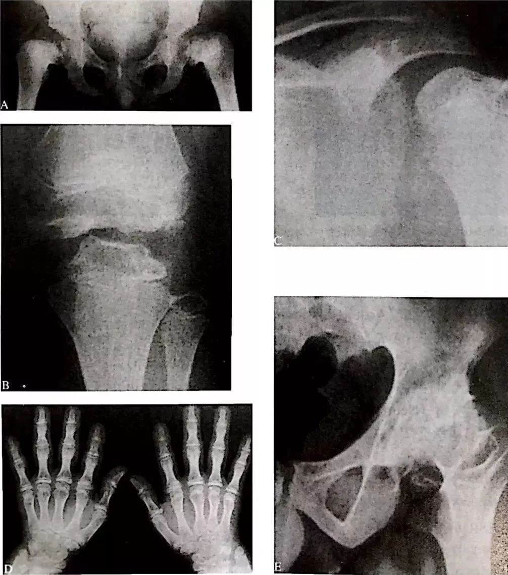 男,14岁,多发骨骺发育不良.
