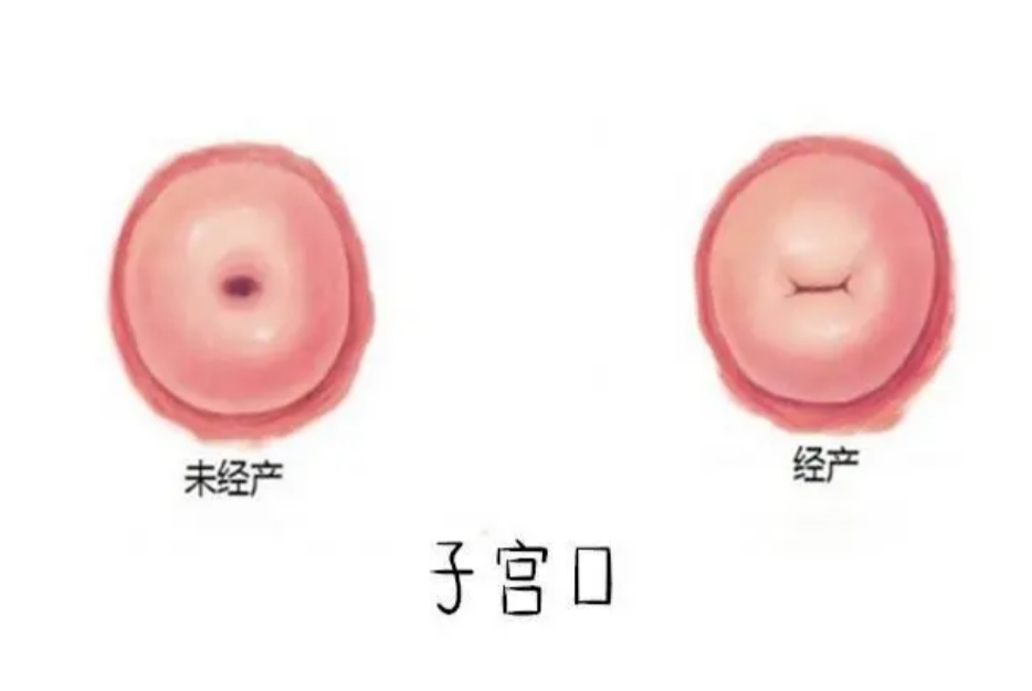 但是生过宝宝的宫颈口变化较大,不再是圆形,而是扁扁的"一字型",有点