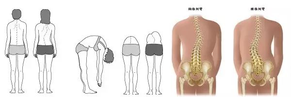 (一)功能性脊椎侧弯,又称非结构性脊柱侧弯,主要是指脊椎弯曲的曲度