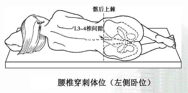 江湖中最神秘的穿刺术之一,有些病想确诊必须靠它