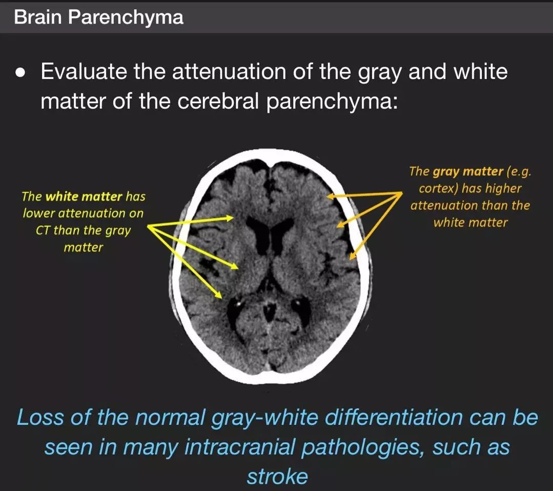 matter)和灰质(gray matter)的密度:灰质密度高于白质正常灰白质难以