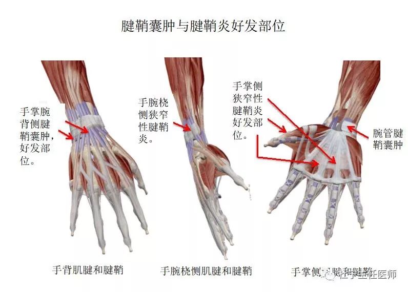 手指屈指肌腱腱鞘炎的病因病理多是肌腱病损变粗,肌腱在腱鞘内运动时